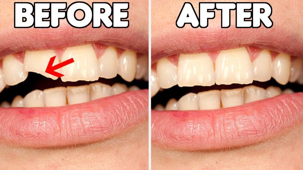 How to Fix a Cracked Tooth Naturally